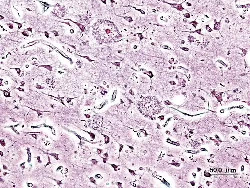 Morbus Alzheimer, Histologie.