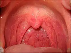die Halsschmerzen = Pharyngitis = Rachen-Entzündung